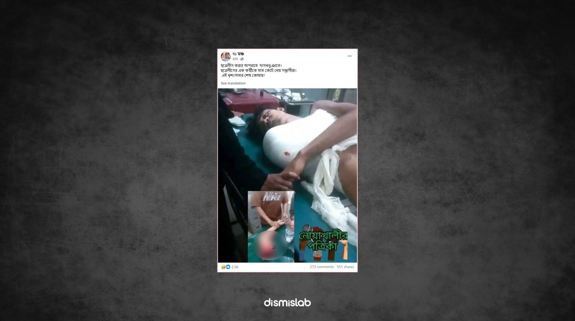 ছাত্রলীগ করায় হাত কেটে ফেলেছে দাবি, অথচ বিচ্ছিন্ন হয়েছে ট্রাকের ধাক্কায় ফ্যাক্টচেক