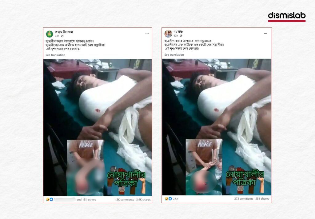 ছাত্রলীগ করায় হাত কেটে ফেলেছে দাবি, অথচ বিচ্ছিন্ন হয়েছে ট্রাকের ধাক্কায়